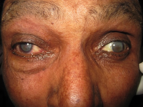 Patient Had Been Suffering from Blindness for Years
